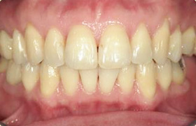 一般的な歯の色