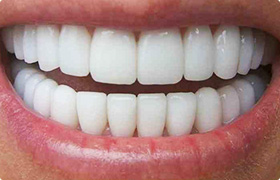 不自然に白い歯の色
